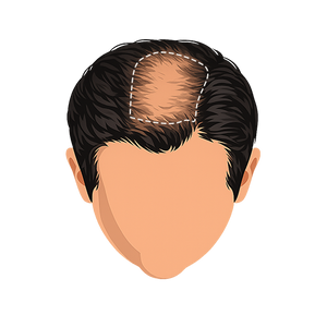 Stage 4